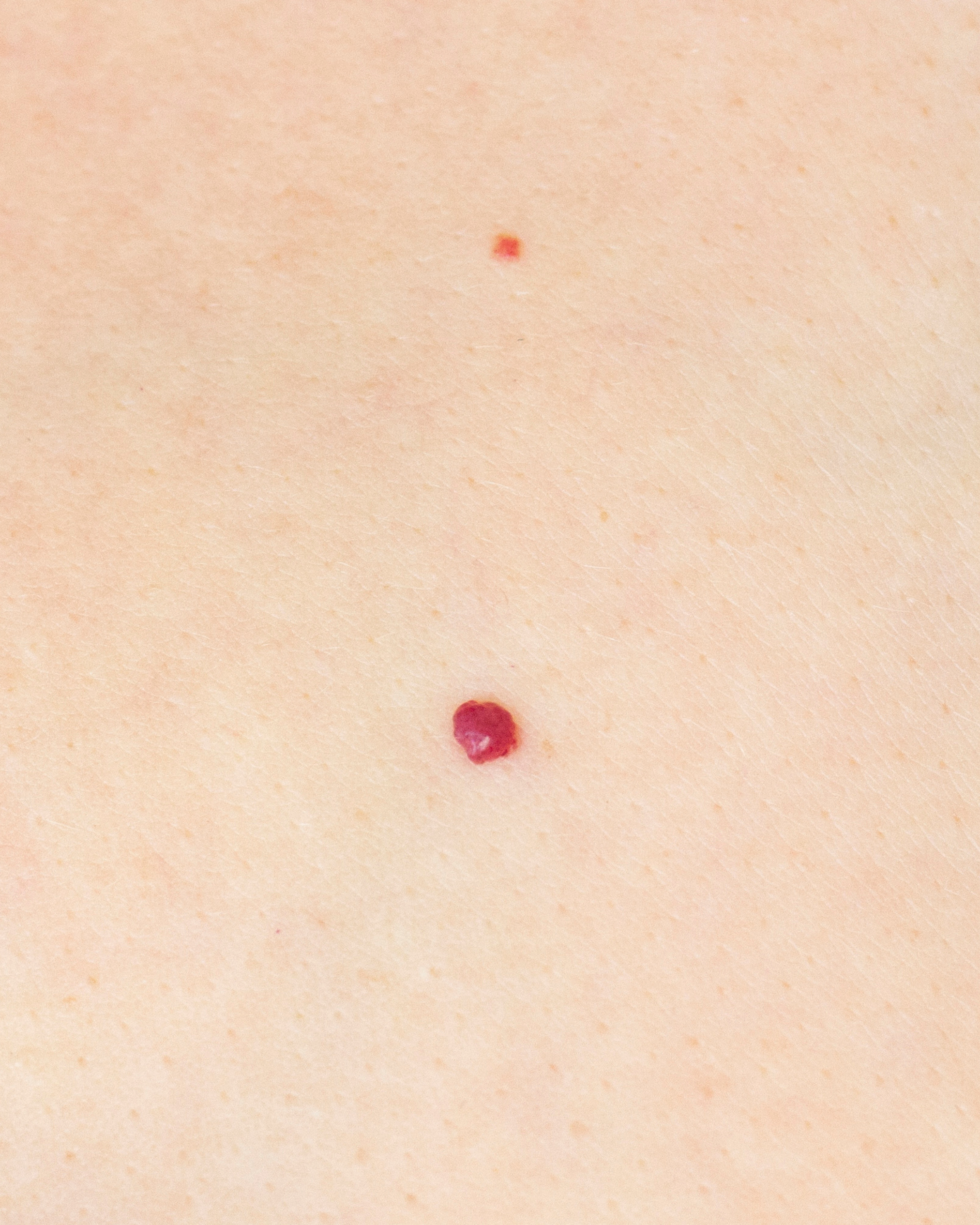Cherry Angioma Removal in Harrogate