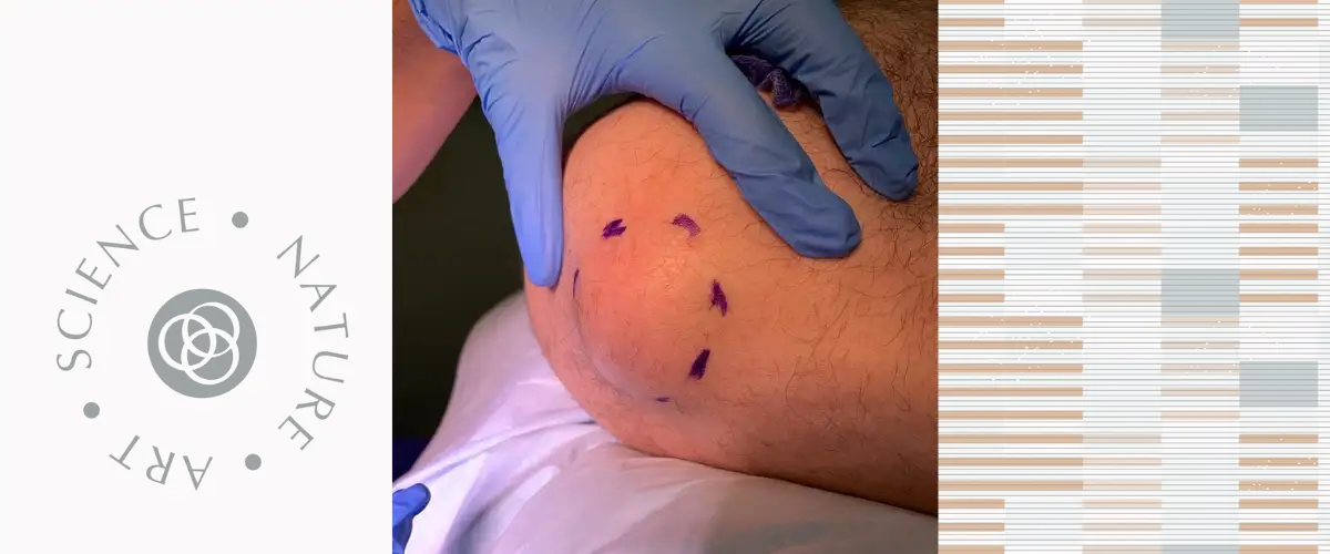 Lipoma on the shoulder