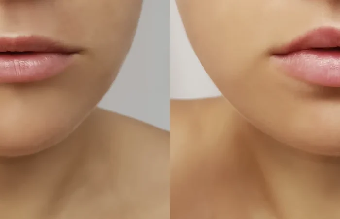 Girl's lips before and after fillers