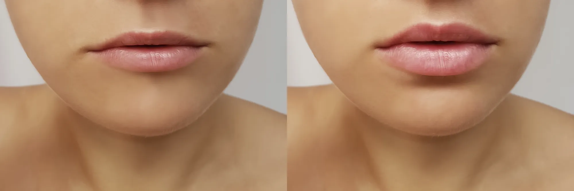 Girl's lips before and after fillers