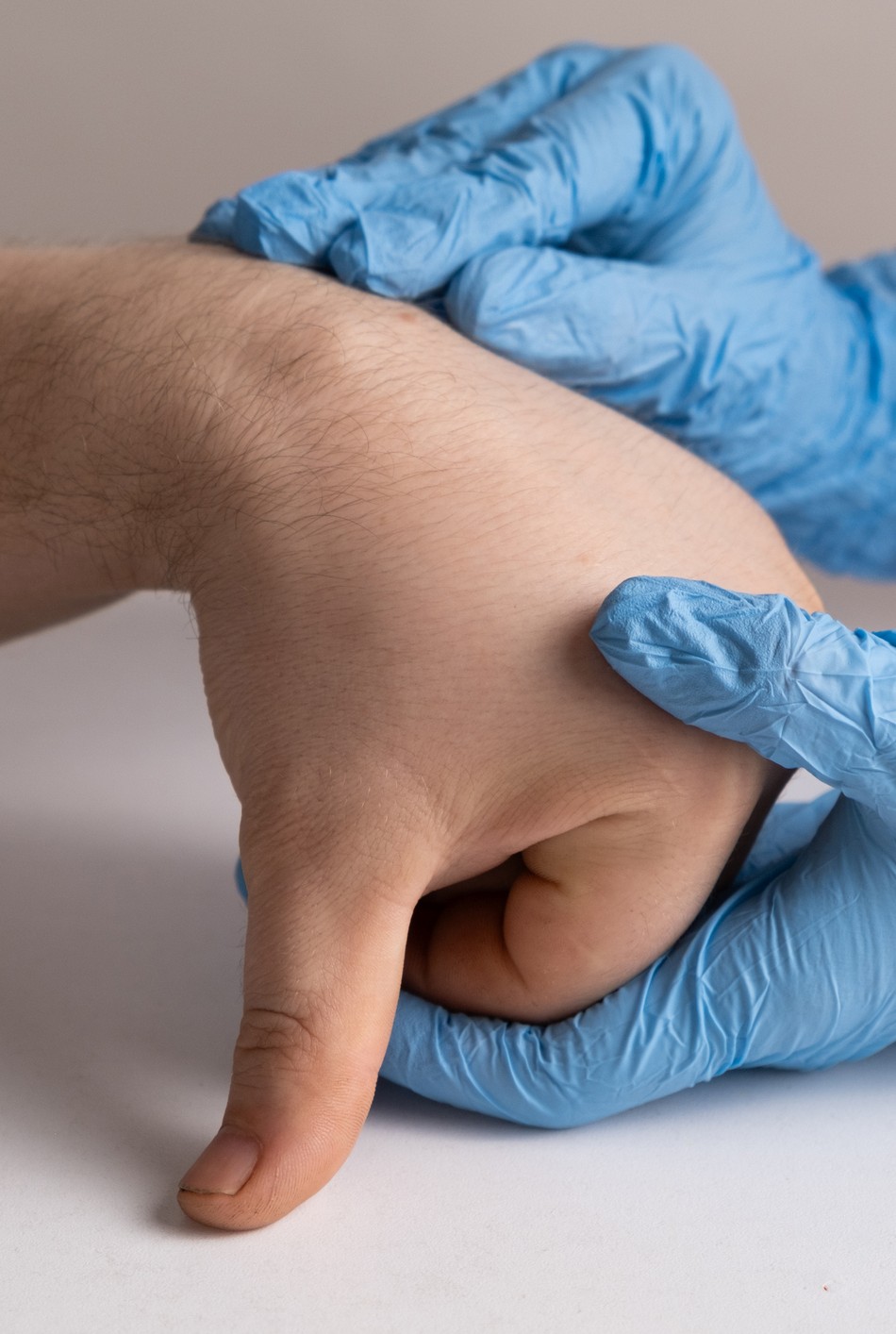 Doctor's gloved hand holding a hand with a cyst on the wrist