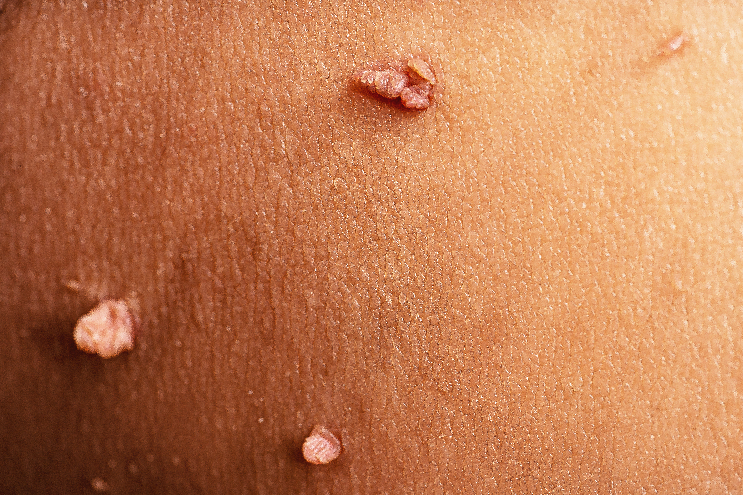 skin tag removal in harrogate