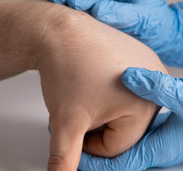 cyst removal in harrogate