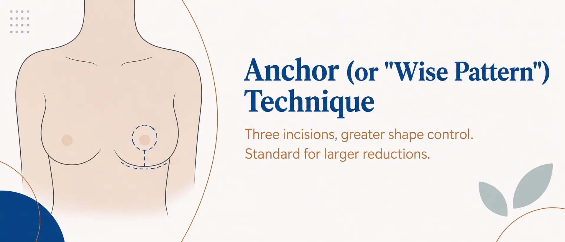Anchor (or "Wise Pattern") technique