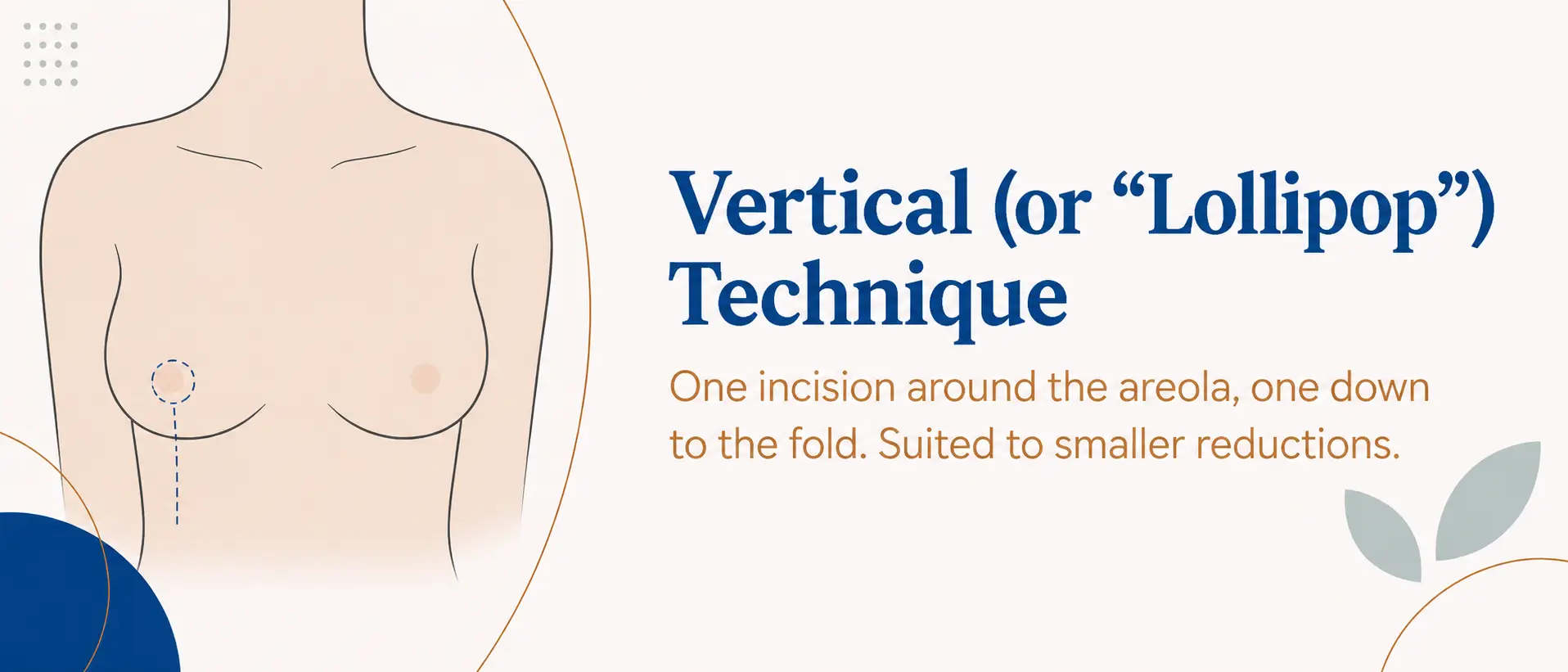 Vertical (or "lollipop") technique