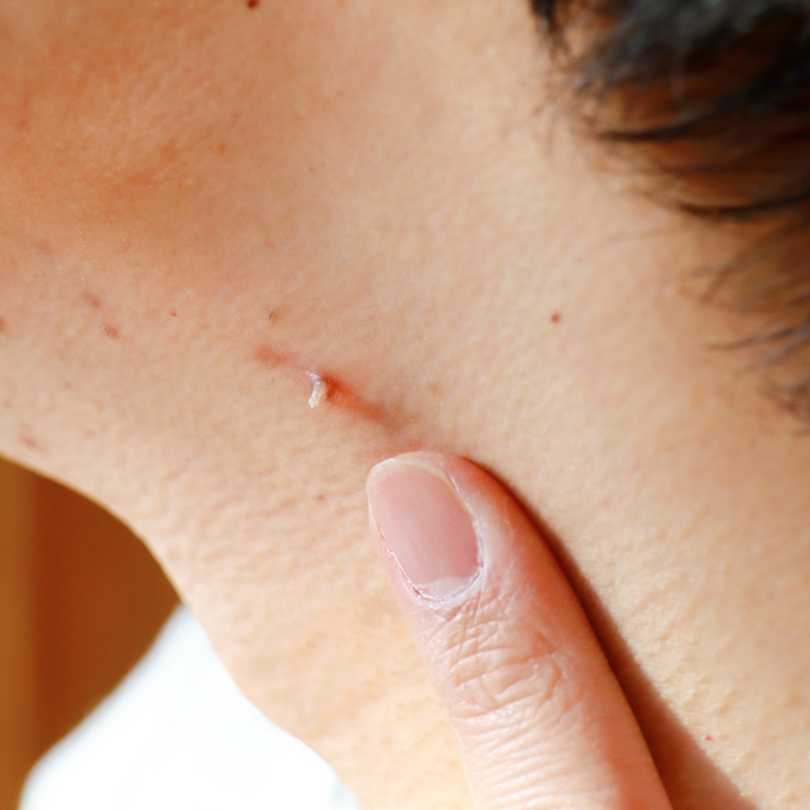 wart removal in harrogate
