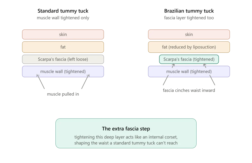 Diagram comparing standard tummy tuck and Brazilian tummy tuck muscle and fascia tightening