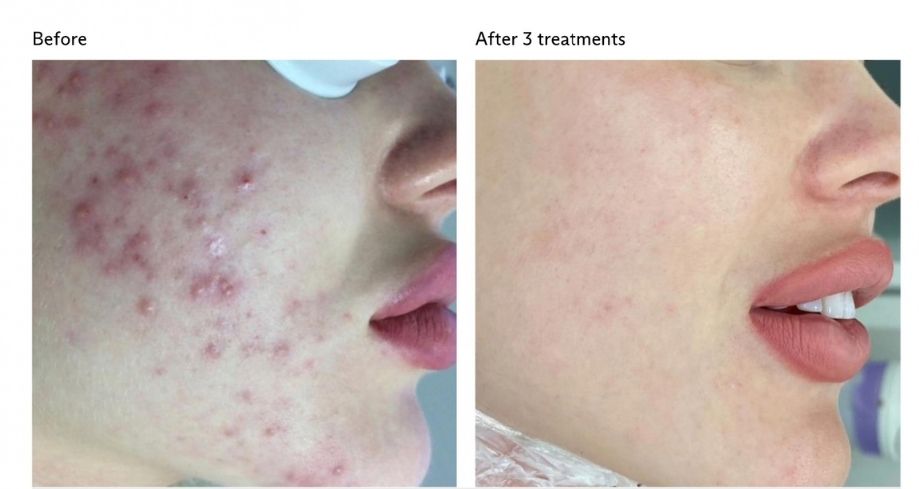 Before and after treatment for acne and acne scars
