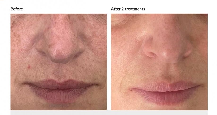 Before and after treatment for pigmentation