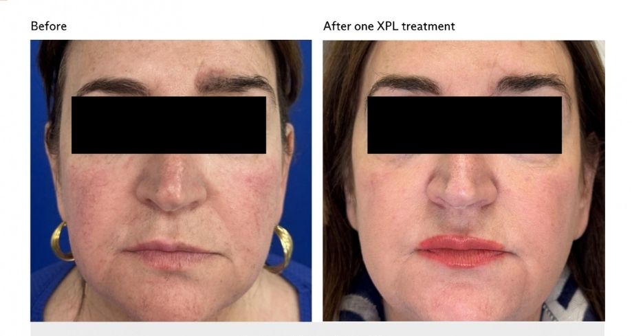 Before and after treatment for redness and rosacea